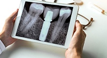 dentist looking at X-ray after ridge expansion for dental implants in Frisco 