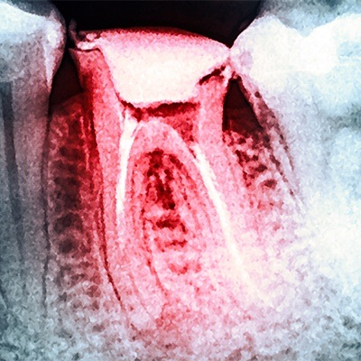 X-ray of damaged tooth