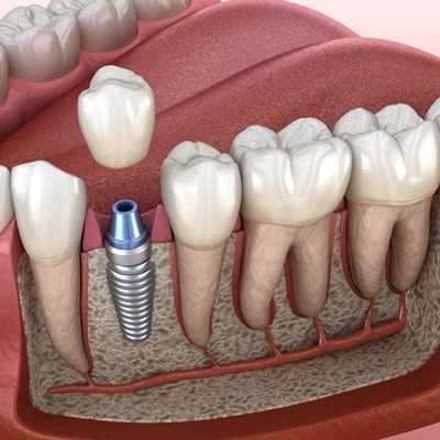 single dental implant with crown in lower arch