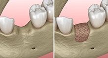 Digital illustration of bone grafting for dental implants in Frisco
