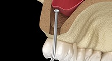 Digital illustration of a sinus lift for dental implants in Frisco