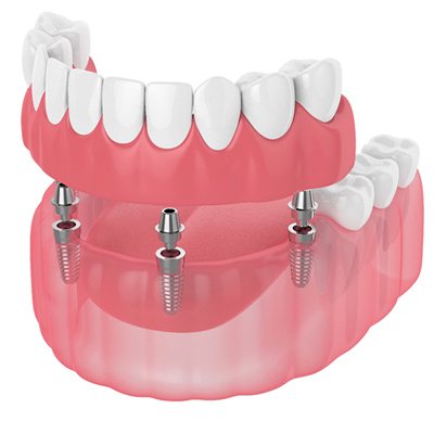 Digital illustration of implant denture in Frisco