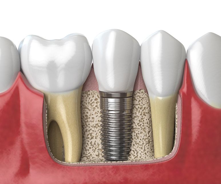 Diagram of dental implants in Frisco after placement