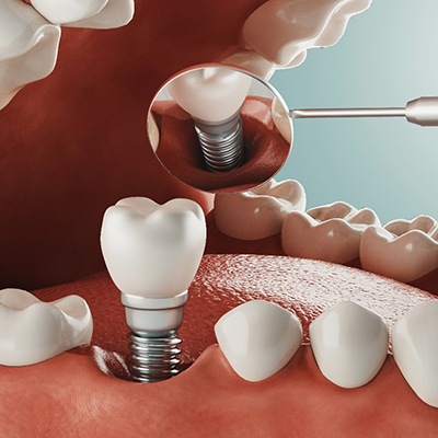 Diagram showing how dental implants in Frisco work