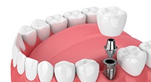 Diagram of a single tooth dental implant in Frisco