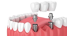 Diagram showing implant bridge replacing multiple missing teeth in Frisco