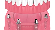 Diagram of an implant denture in Frisco