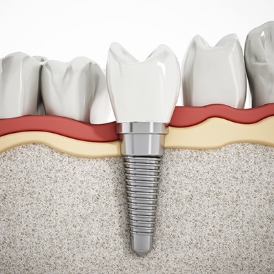 Animation of implant supported replacement tooth