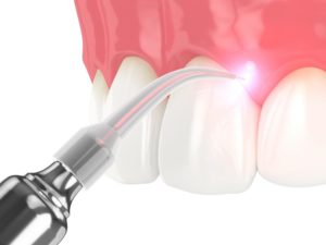 Illustration of soft tissue laser used by dentist in Frisco