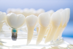 Dental implant in plastic tray next to model teeth